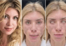 El drama de Yulia Tarasevich: una cirugía estética le cambió la vida para siempre